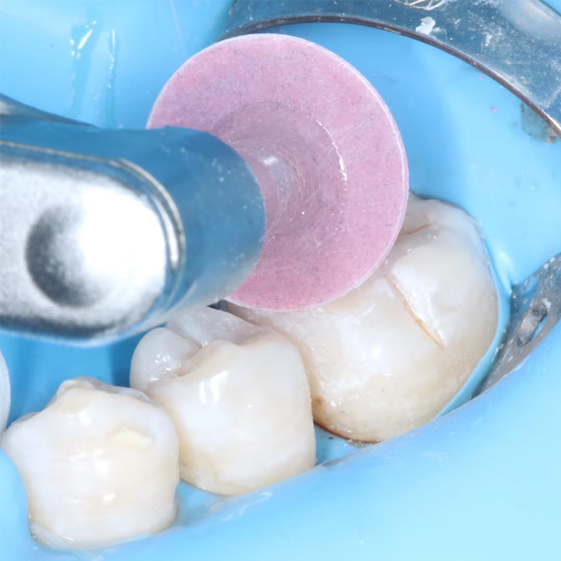 40 szt. Dyski polerskie dentys – Teeth Whitening Home recenzja i cena