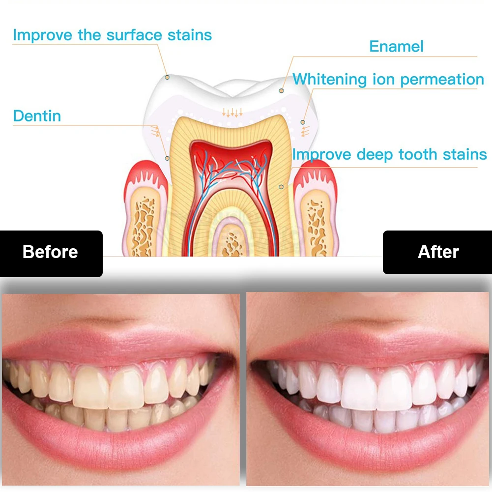 Zestaw do wybielania zębów den – Teeth Whitening App recenzja i cena